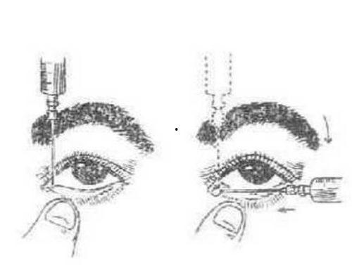 泪道冲洗视频,泪道冲洗操作步骤及要点解析
